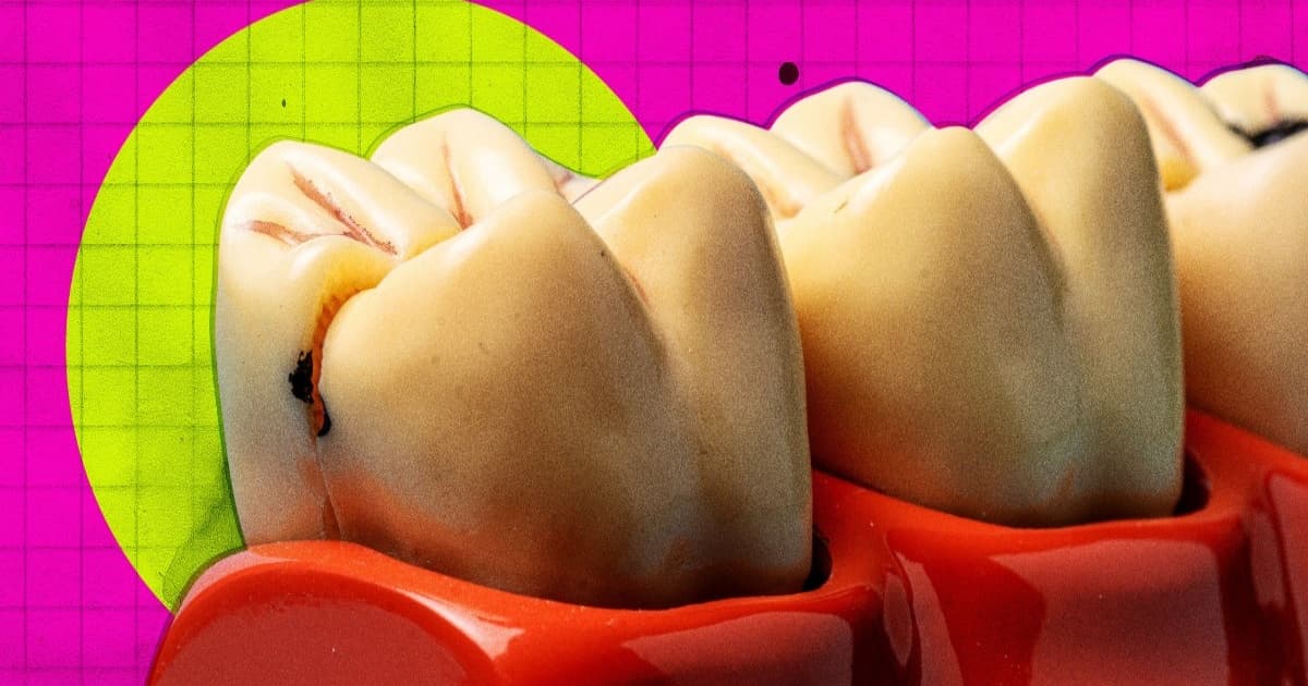 Ilustrasi model gigi menunjukkan kerusakan gigi untuk artikel regenerasi gigi